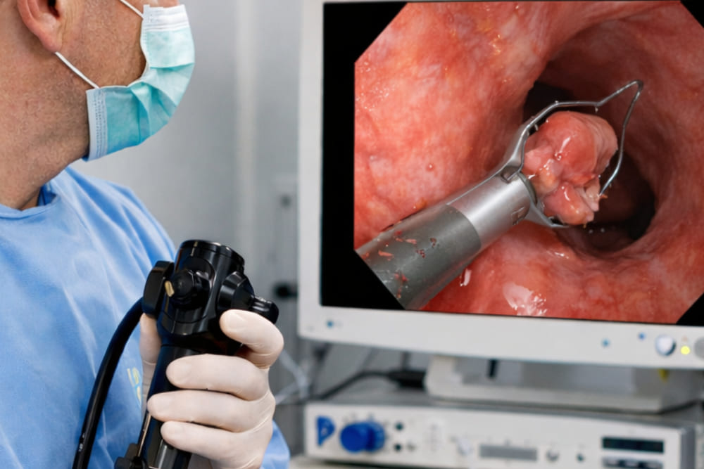 Polipectomías o resección de pólipos en CDMX: tratamiento endoscópico para la prevención del cáncer gastrointestinal
